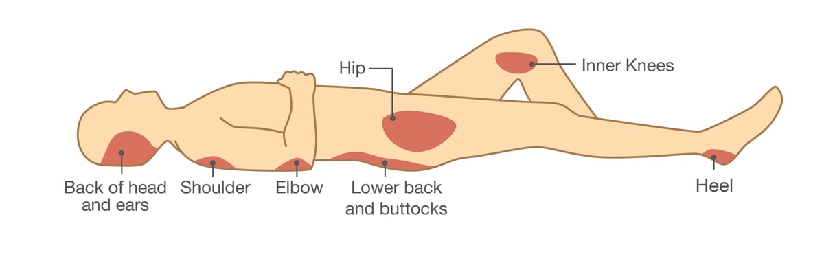 illustration supine body with highlighting areas at high risk for pressure injury prevention and treatment