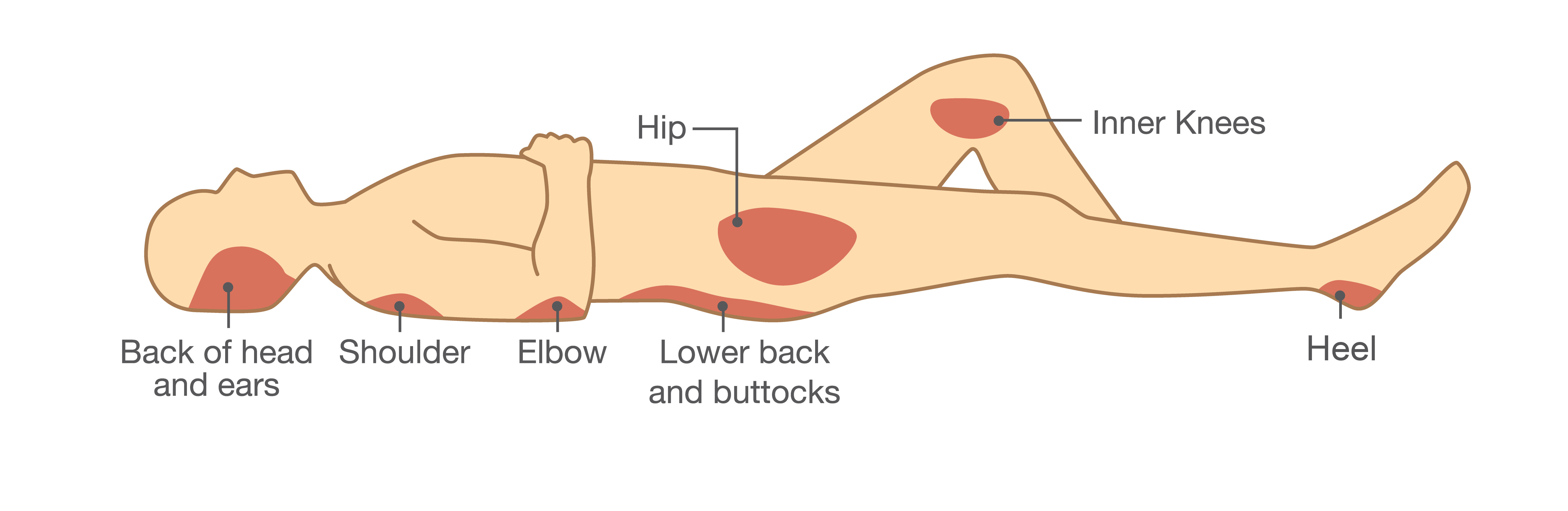 Body Positioning Injuries Airisana | Guide to Pressure Injury Prevention