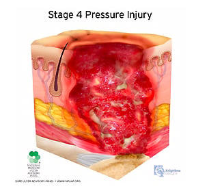medical illustration stage four pressure injury cutaway cross section