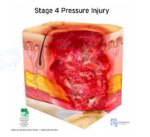 medical illustration stage four pressure injury cutaway cross section