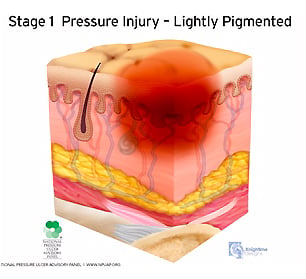 medical illustration stage one pressure injury cutaway cross section