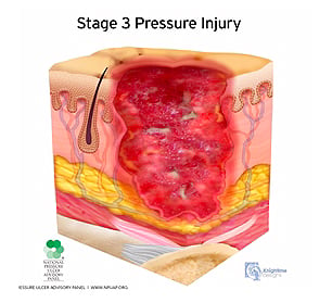medical illustration stage three pressure injury cutaway cross section