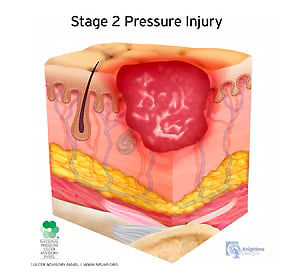 medical illustration stage two pressure injury cutaway cross section