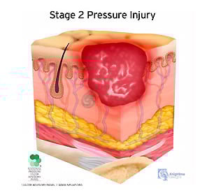 medical illustration stage two pressure injury cutaway cross section