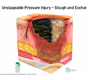 medical illustration unstageable pressure injury with slough and eschar